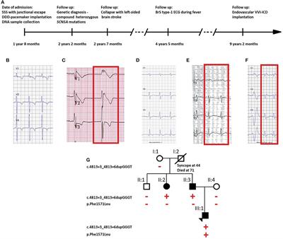 Compound Heterozygous SCN5A Mutations in Severe Sodium Channelopathy With Brugada Syndrome: A Case Report